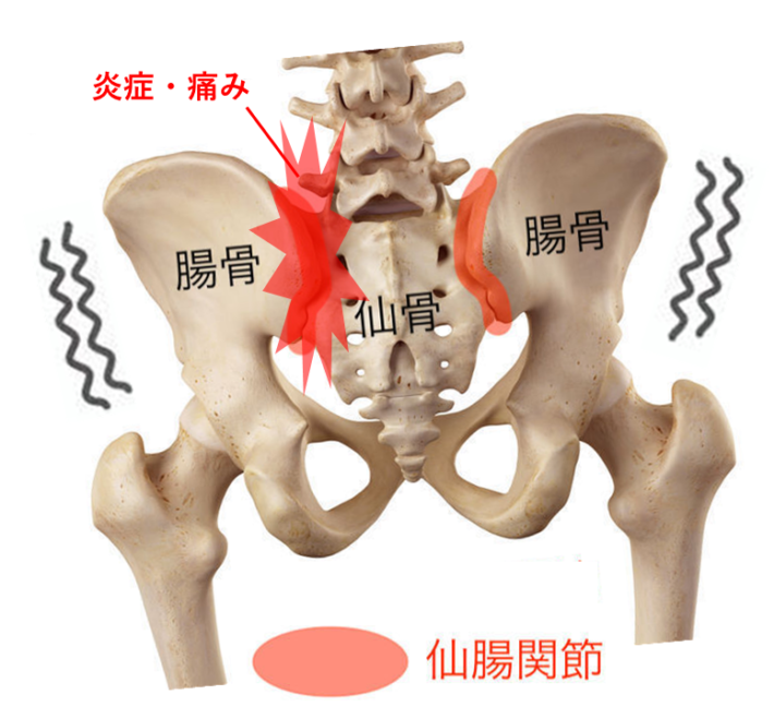 仙骨が痛い、、これって仙骨の障害?関節炎が起きる原因について専門的に解説 - にこにこ整体・整骨院